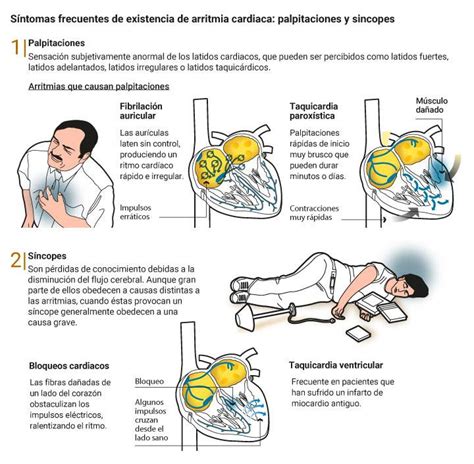 que es una arritmia cardiaca